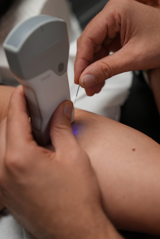 Dry needling échoguidé — aiguille et sonde sur le muscle