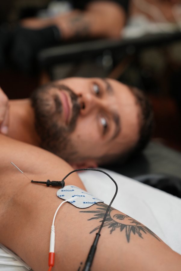Neuromodulation percutanée avec électrodes