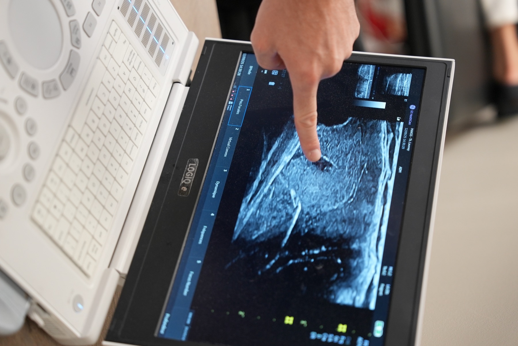 C'est quoi la neuromodulation percutanée ?